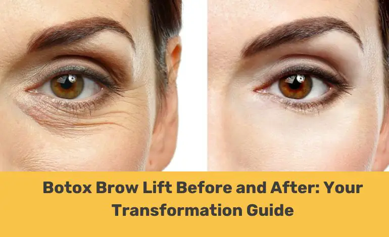 Botox brow lift before and after