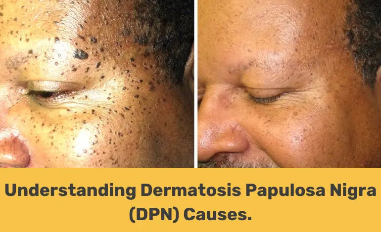 dpn causes