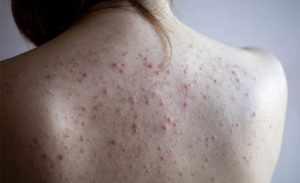 DIY Acne Spot Treatments