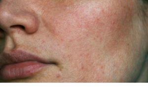 Winter Skincare for Dry Skin 